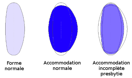 Accommodation incomplète avec presbytie