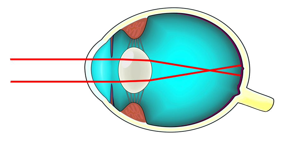 Oeil de myope trop long